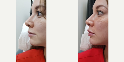 Restylane before and after photo