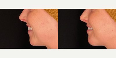 Chin Filler before and after photo