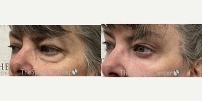Eyelid Surgery before and after photo