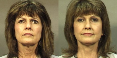 Facelift before and after photo