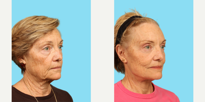 Facelift before and after photo