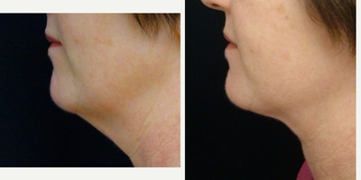 Neck Lift before and after photo