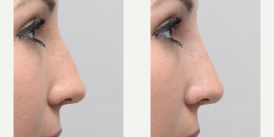 Nonsurgical Nose Job before and after photo