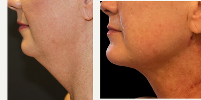 Renuvion before and after photo