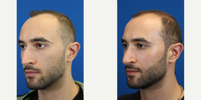 Rhinoplasty before and after photo