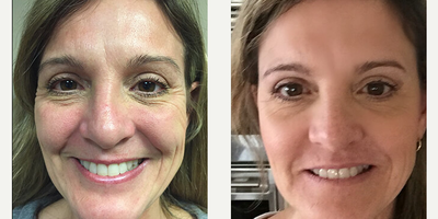 Botox before and after photo