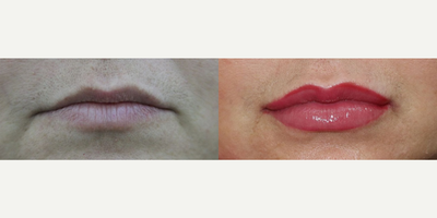 Dermal Fillers before and after photo