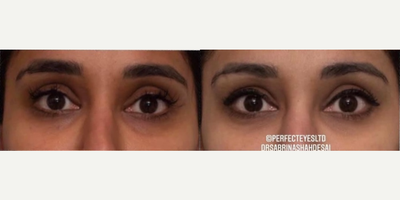 Dermal Fillers before and after photo