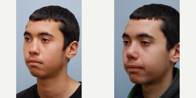 Rhinoplasty before and after photo