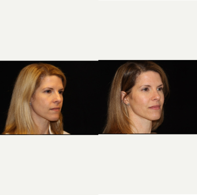 Rhinoplasty before and after photo