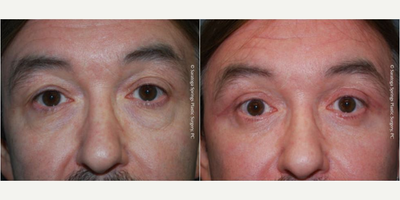 Eyelid Surgery before and after photo