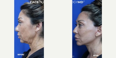 Neck Lift before and after photo
