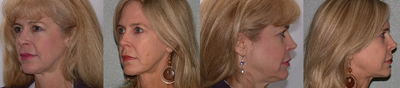 Cheek Lift before and after photo
