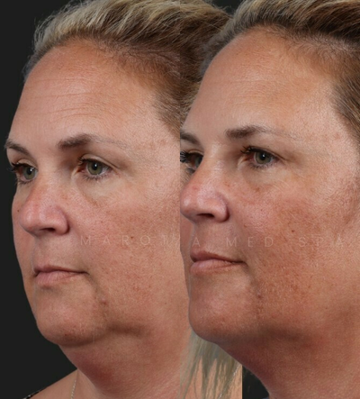 Chin Filler before and after photo