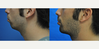 Chin Implant before and after photo
