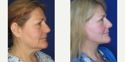 Neck Lift before and after photo