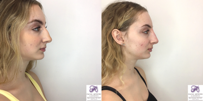 Nonsurgical Nose Job before and after photo