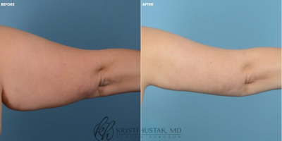 Arm Lift before and after photo