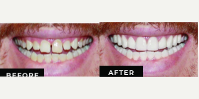Porcelain Veneers before and after photo