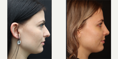 Rhinoplasty before and after photo