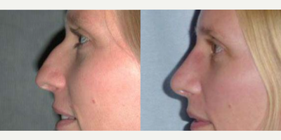 Rhinoplasty before and after photo