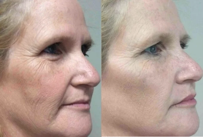Voluma before and after photo