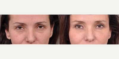 Eyelid Surgery before and after photo