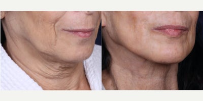 Facelift before and after photo