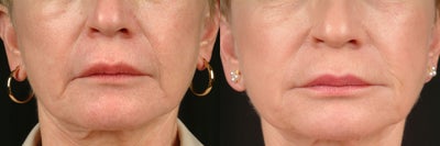 Juvederm before and after photo