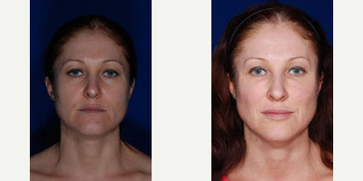 Laser Resurfacing before and after photo