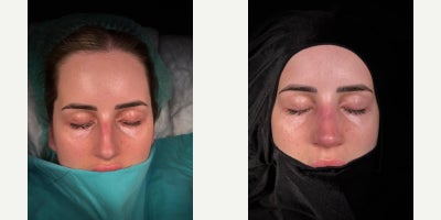 Cheek Fillers before and after photo