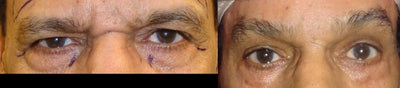 Eyelid Surgery before and after photo