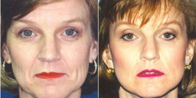 Facelift before and after photo