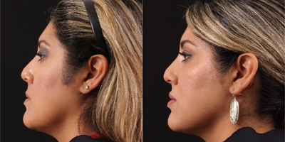 Lip Fillers before and after photo