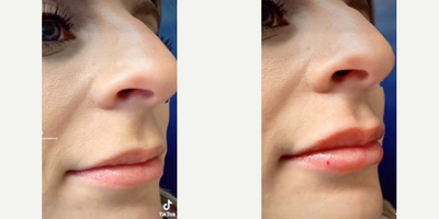 Restylane Silk before and after photo