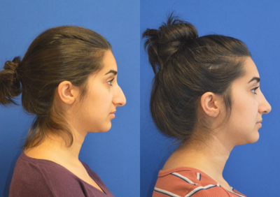 Rhinoplasty before and after photo