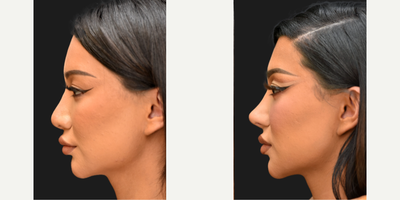 Rhinoplasty before and after photo
