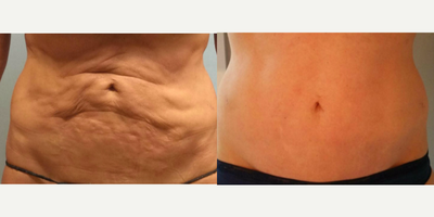 Tummy Tuck before and after photo