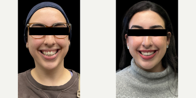 Botox for Gummy Smile before and after photo
