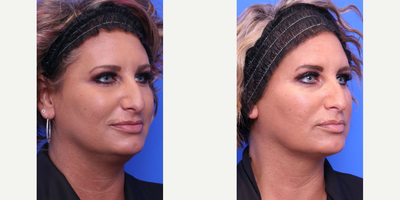 Chin Liposuction before and after photo