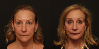 Facelift before and after photo