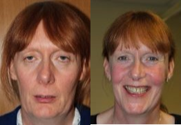 Facial Feminization Surgery before and after photo