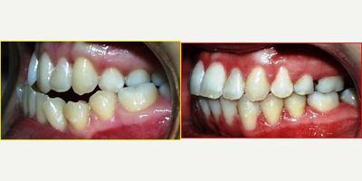 Jaw Surgery before and after photo