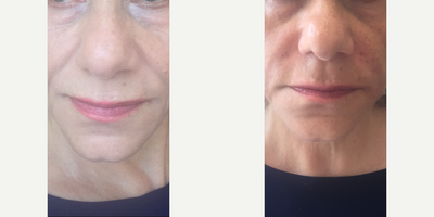 Juvederm before and after photo
