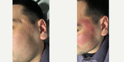 Microneedling before and after photo