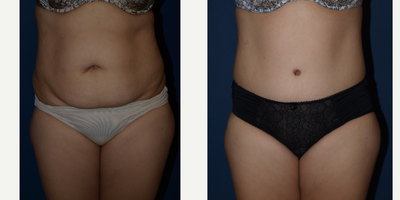 Tummy Tuck before and after photo
