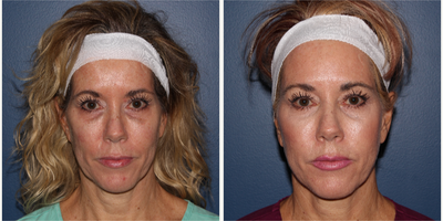 Bellafill before and after photo