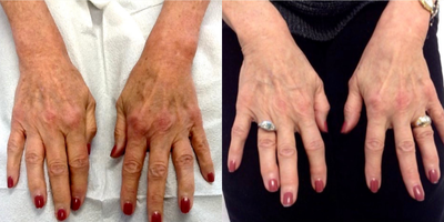 IPL before and after photo