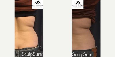 SculpSure before and after photo