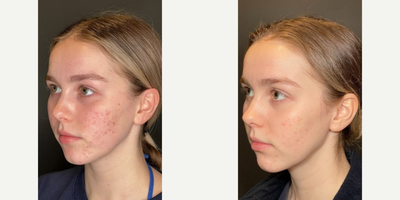 AviClear before and after photo